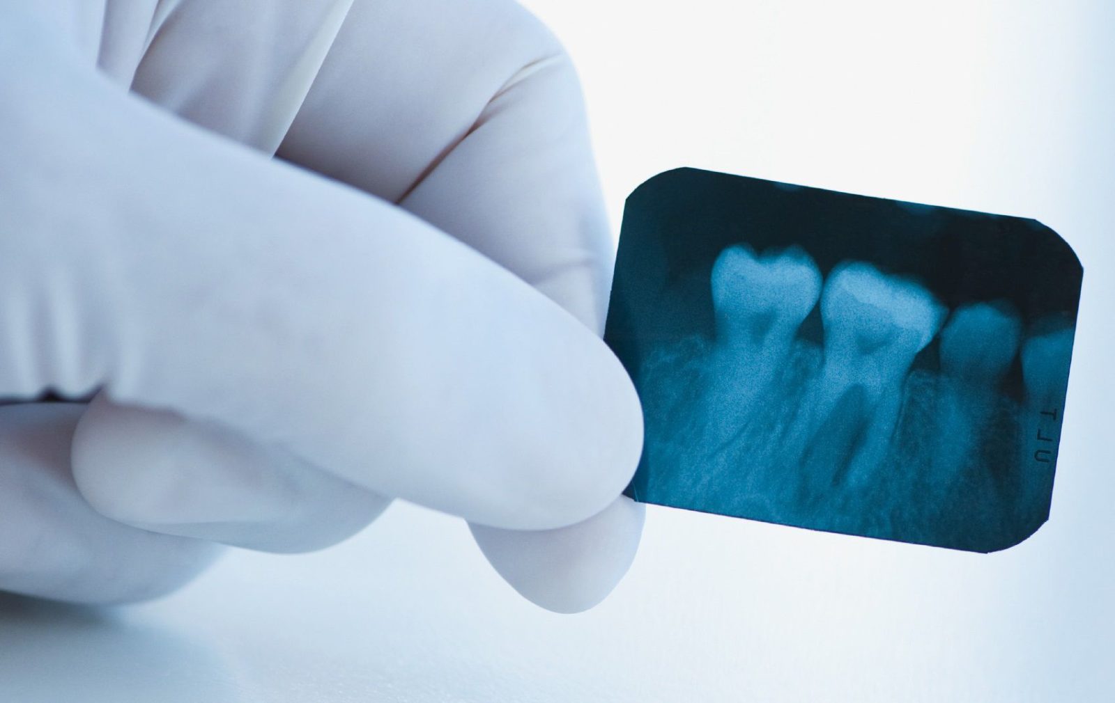 Важность рентгеновских снимков зубов в современной стоматологии