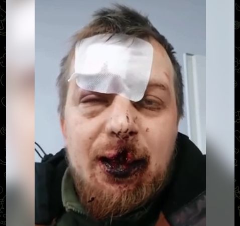 Пытались убить за &laquo;гроши на ВСУ&raquo;: волонтёра жестоко избили молотками и кастетами