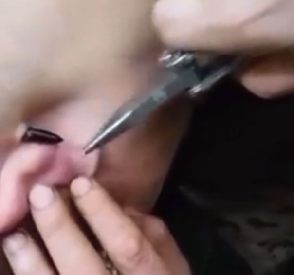 "В бронежилете родился!". У российского бойца под кожей за ухом застряла пуля